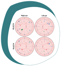Eine Grafik aus der Forschungsarbeit zeigt eine Vereinfachung von Augenkrankheiten. Dabei sind jeweils zwei rechte und zwei linke Augen als Kreise dargestellt, in denen mit verschiedenen Farben Punkte und größere Kreise dargestellt sind.